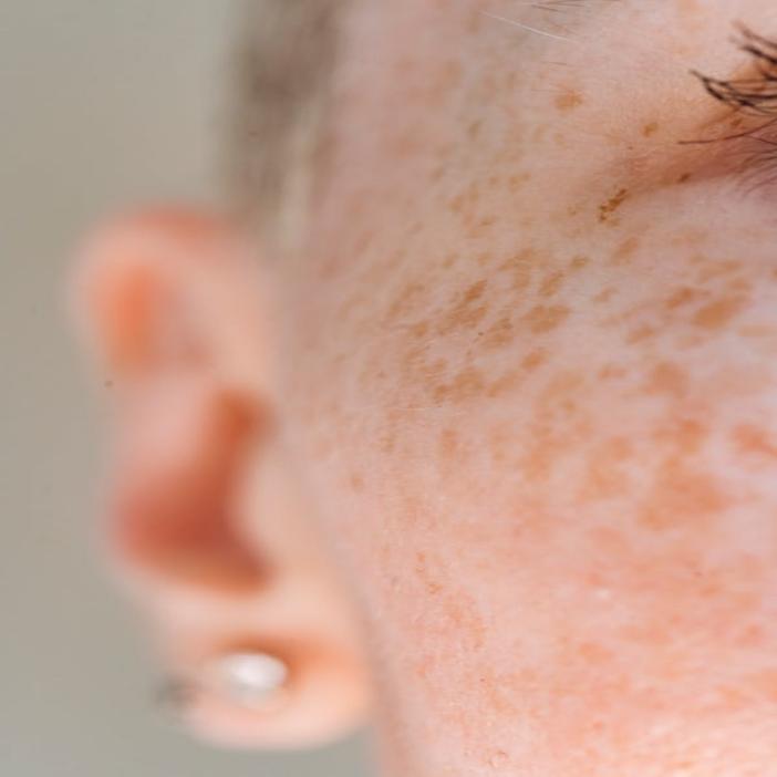 Red Light Therapy for Melasma, Hyperpigmentation, and Uneven Skin Tone