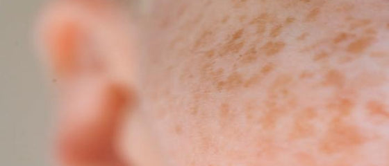 Red Light Therapy for Melasma, Hyperpigmentation, and Uneven Skin Tone