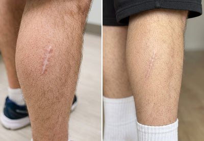 Scars