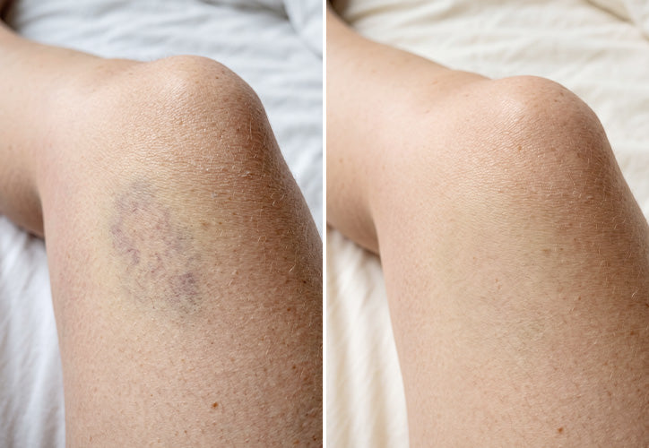 Bruise