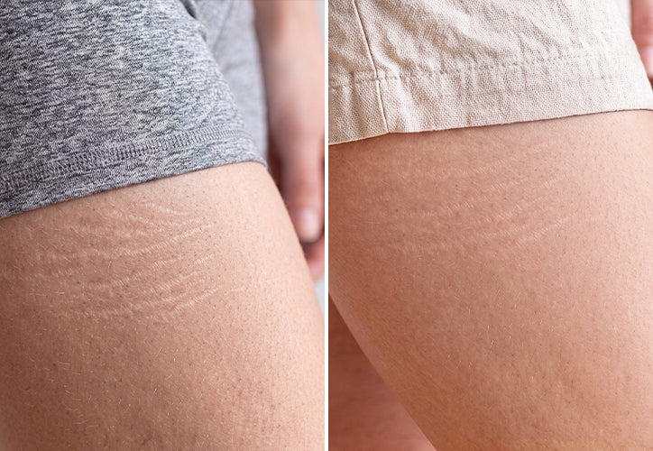 Wrinkles