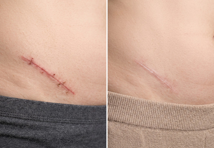 Scars