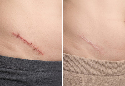 Scars